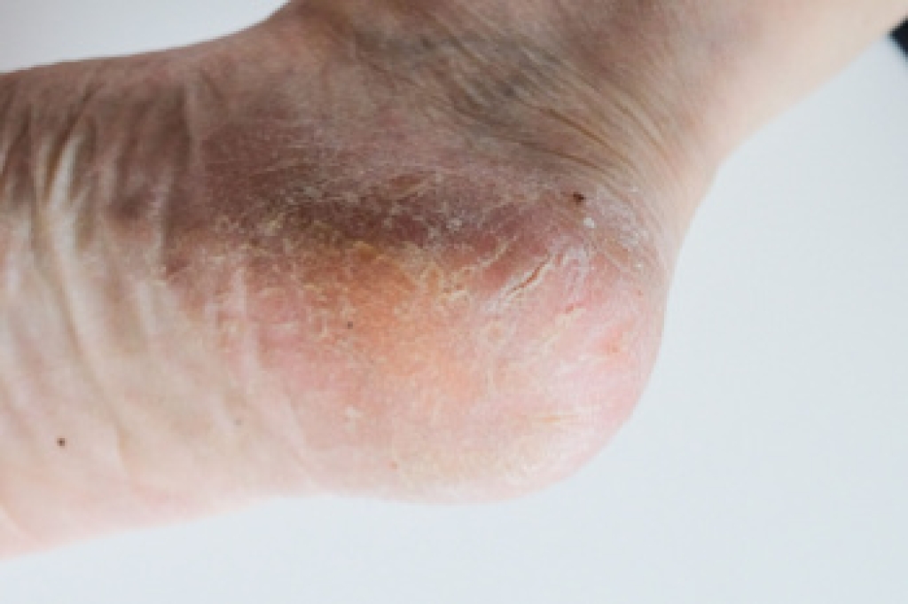 Reasons Cracked Heels Develop