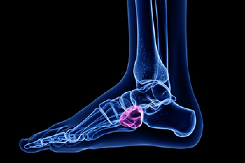 Outer Foot Pain and Cuboid Syndrome