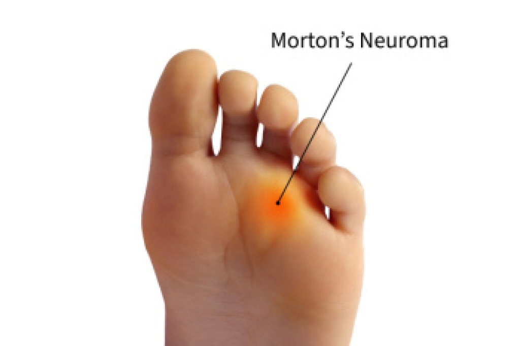 Foot Pain With Morton’s Neuroma