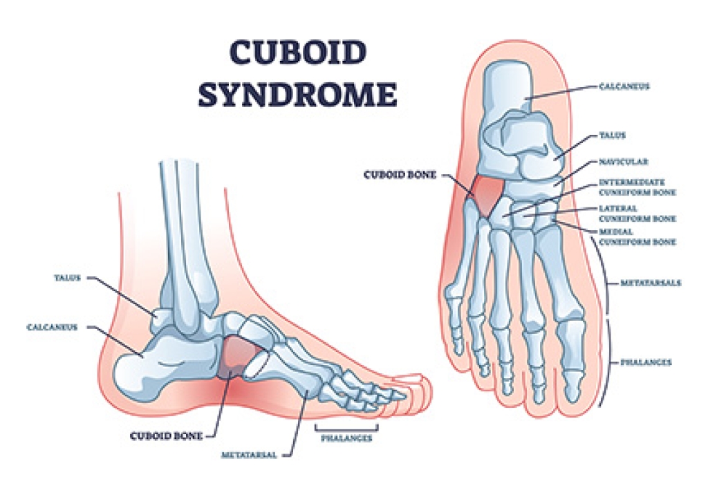 Cuboid Syndrome and Foot Pain