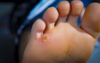 Differences Between Calluses and Corns on the Feet