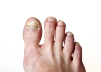 What Is Used to Treat Toenail Fungus?