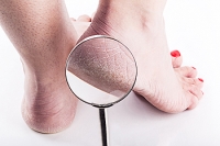 How To Find Relief From Cracked Heels