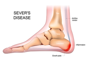 Symptoms and Relief From Sever’s Disease